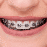 Orthometric Brackets Metalicos Advanced Series MBT 0.022" Incluye Arcos 0.014 Sup/Inf y Tubos (1 Caso) - Imagen 3