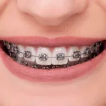 Orthometric Brackets Metalicos Advanced Series Roth 0.022" (10 Casos) - Imagen 3